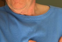 Diferencia entre ictus, infarto y paro cardíaco
