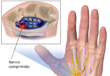 Cuándo aparece el síndrome del túnel carpiano