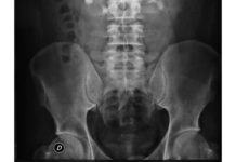 ¿Cuándo implantar una prótesis de cadera?