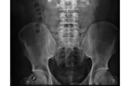 Información sobre las prótesis de cadera