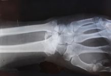 Ácido hialurónico para las articulaciones