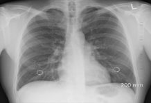 ¿Cuáles son los síntomas de una neumonía? ¿Cuáles son los síntomas de una neumonía?