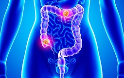 Cómo prevenir el cáncer de colon Cómo prevenir el cáncer de colon